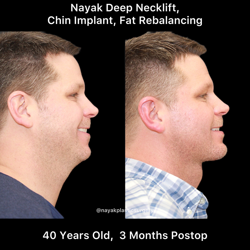 Chin Implants Before & After Image