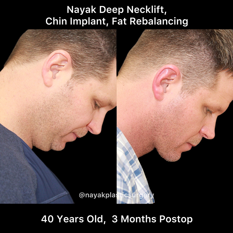 Chin Implants Before & After Image