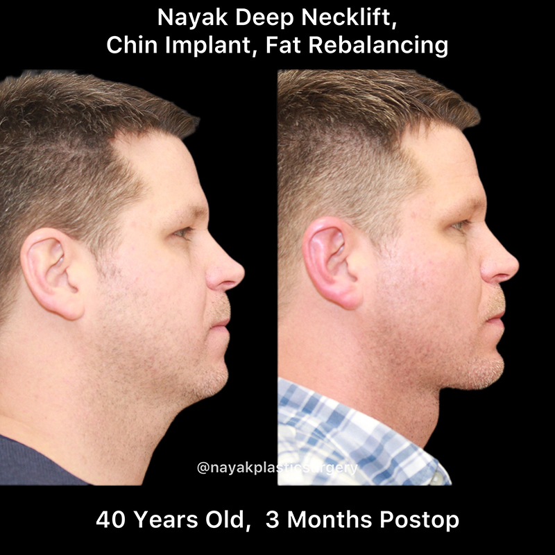 Chin Implants Before & After Image