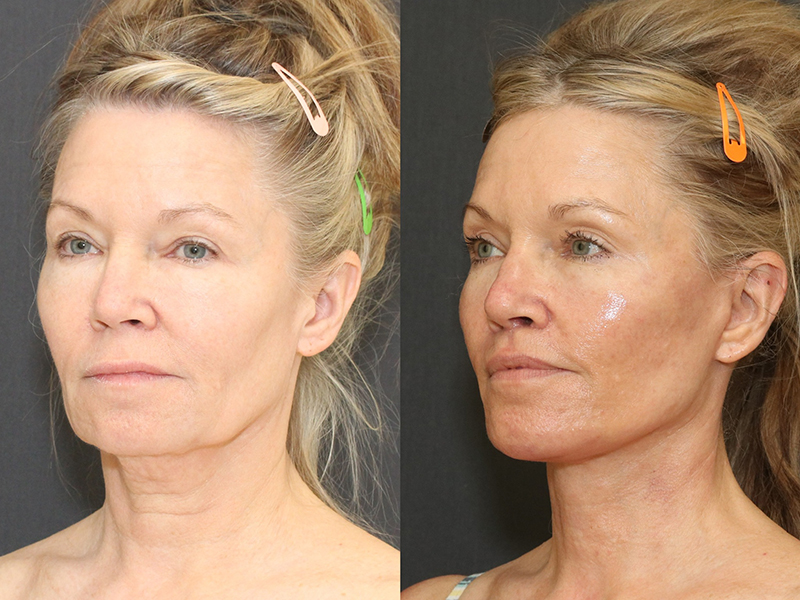 Chin Implants Before & After Image