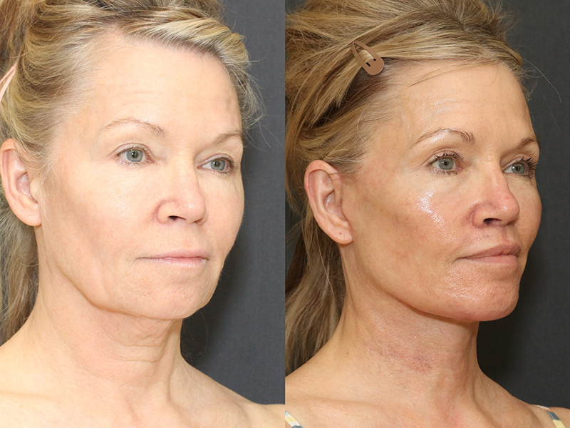 Chin Implants Before & After Image