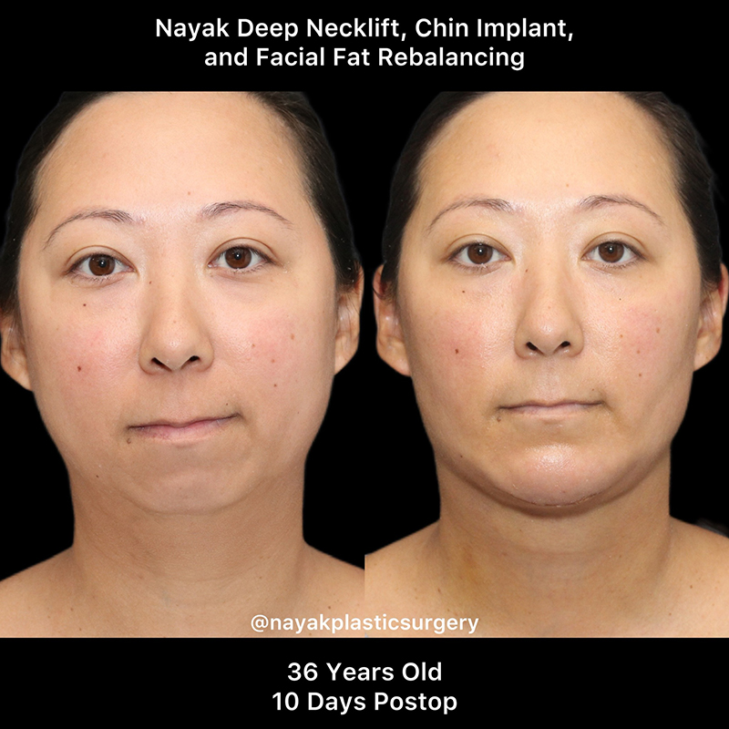 Chin Implants Before & After Image