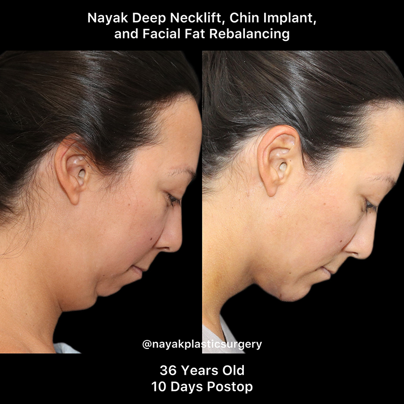 Chin Implants Before & After Image