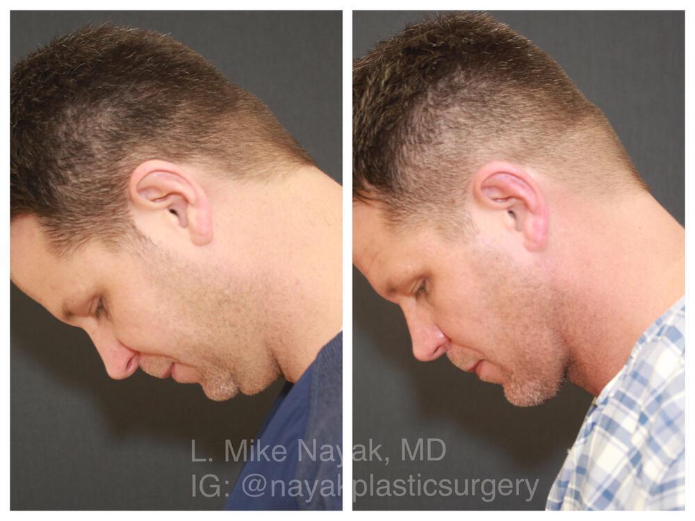 Deep Necklift Before & After Image