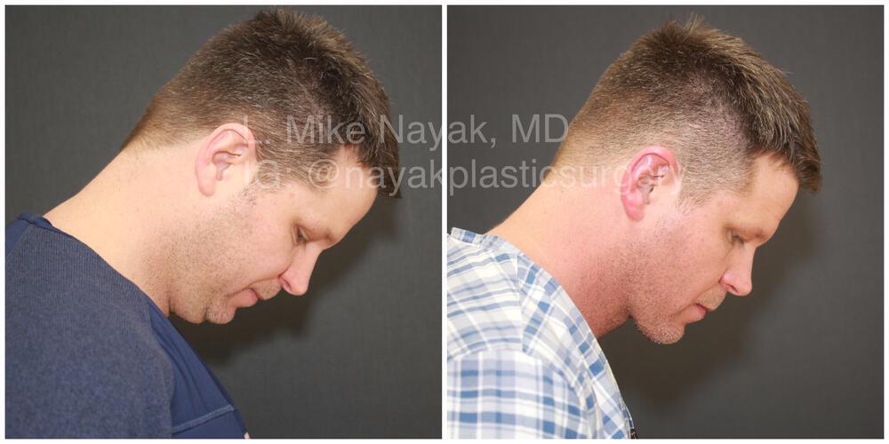 Deep Necklift Before & After Image