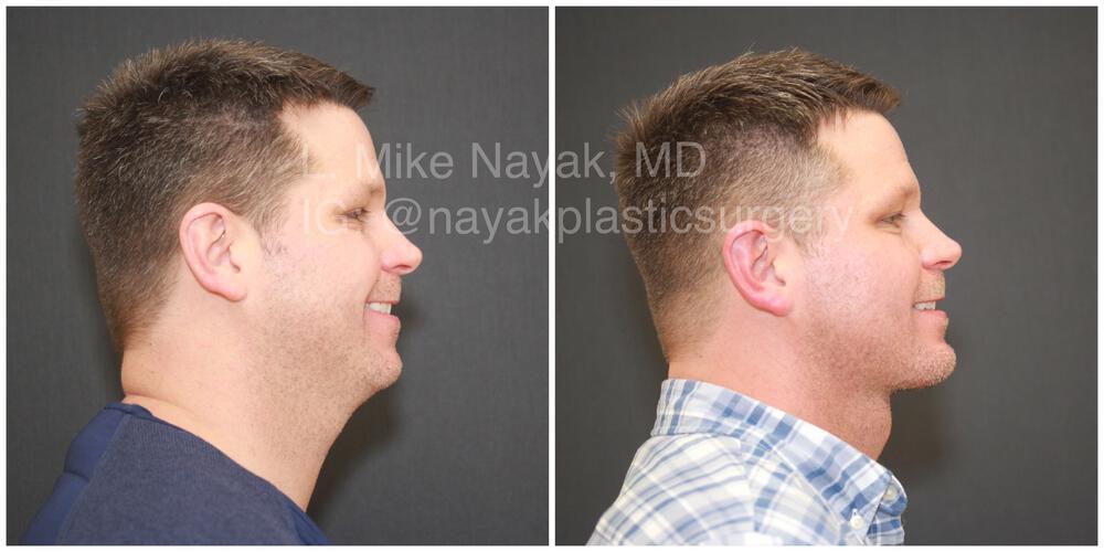 Deep Necklift Before & After Image