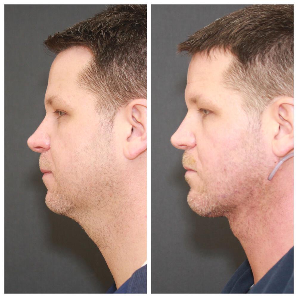 Deep Necklift Before & After Image