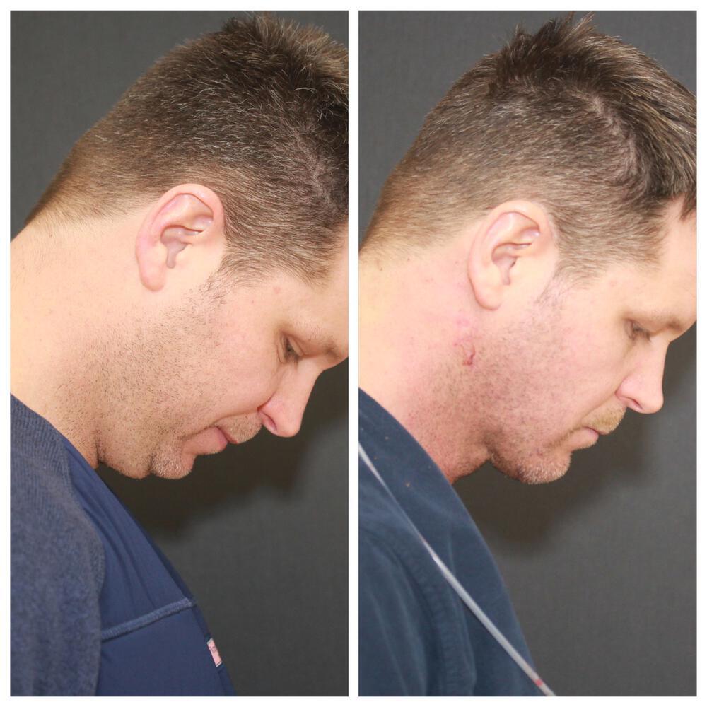 Deep Necklift Before & After Image