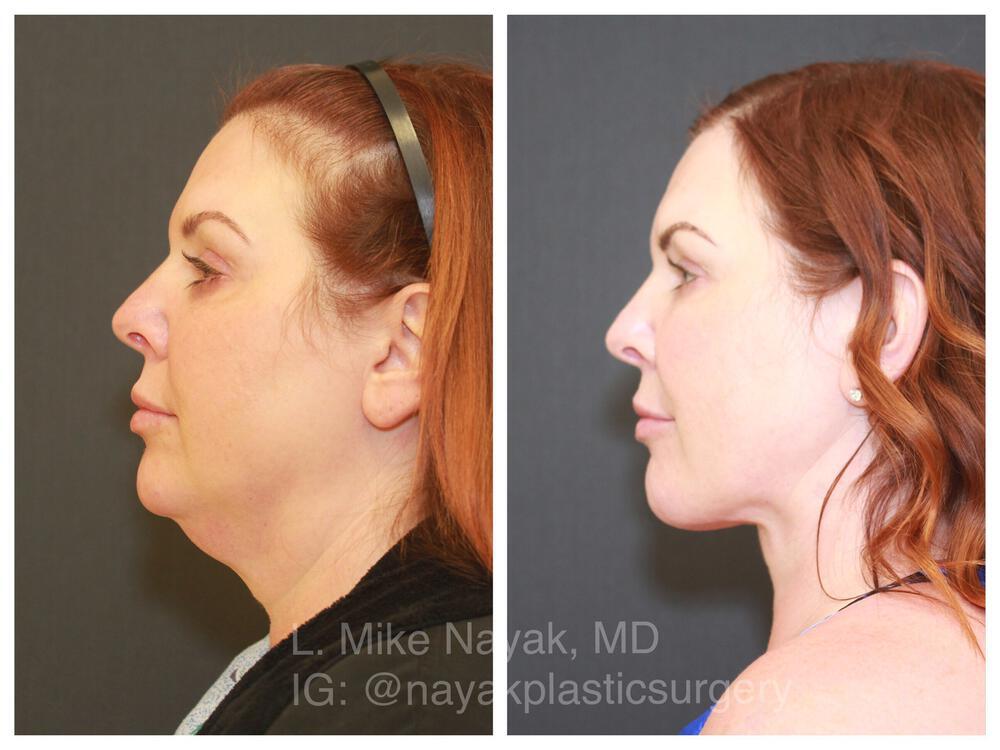 Deep Necklift Before & After Image