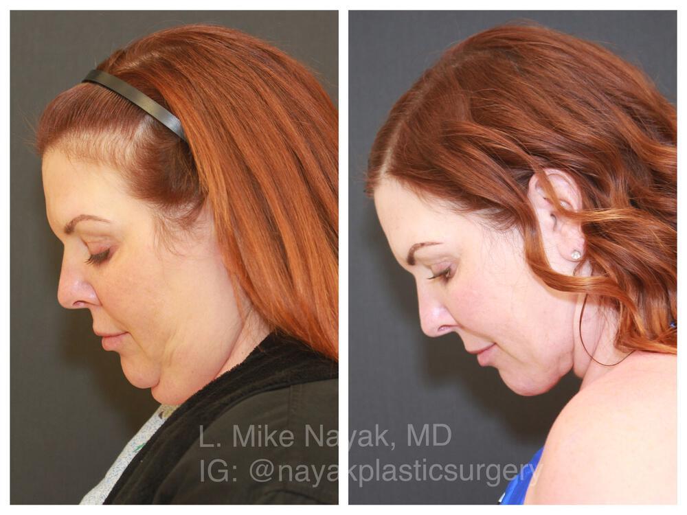 Deep Necklift Before & After Image