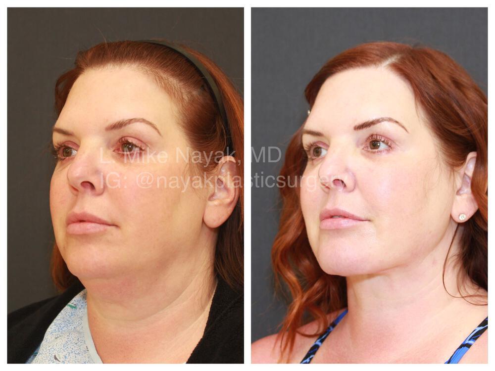 Deep Necklift Before & After Image