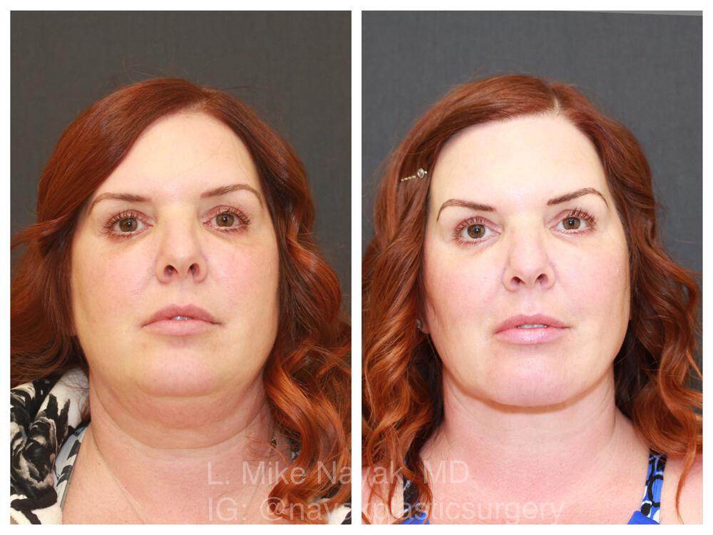 Deep Necklift Before & After Image