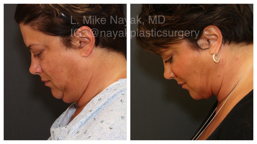 Deep Necklift Before & After Image