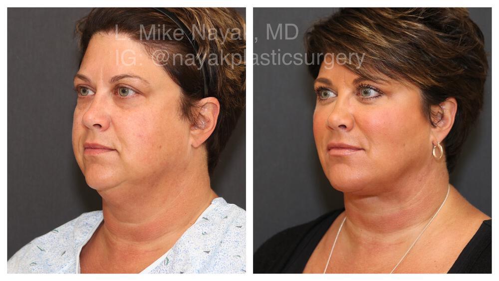 Deep Necklift Before & After Image