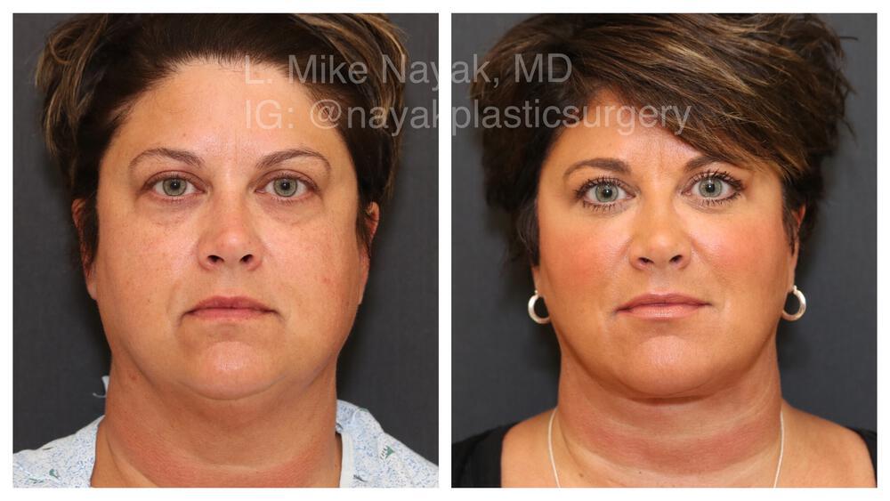 Deep Necklift Before & After Image