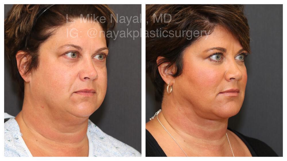 Deep Necklift Before & After Image