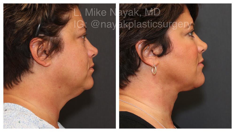 Deep Necklift Before & After Image