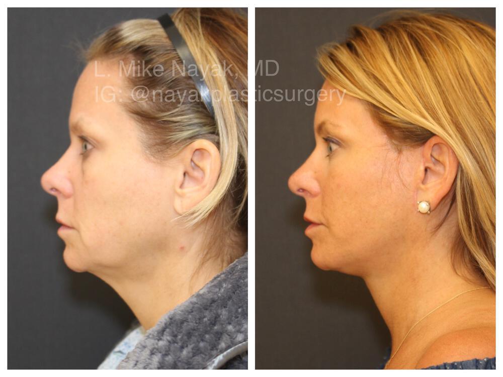 Deep Necklift Before & After Image