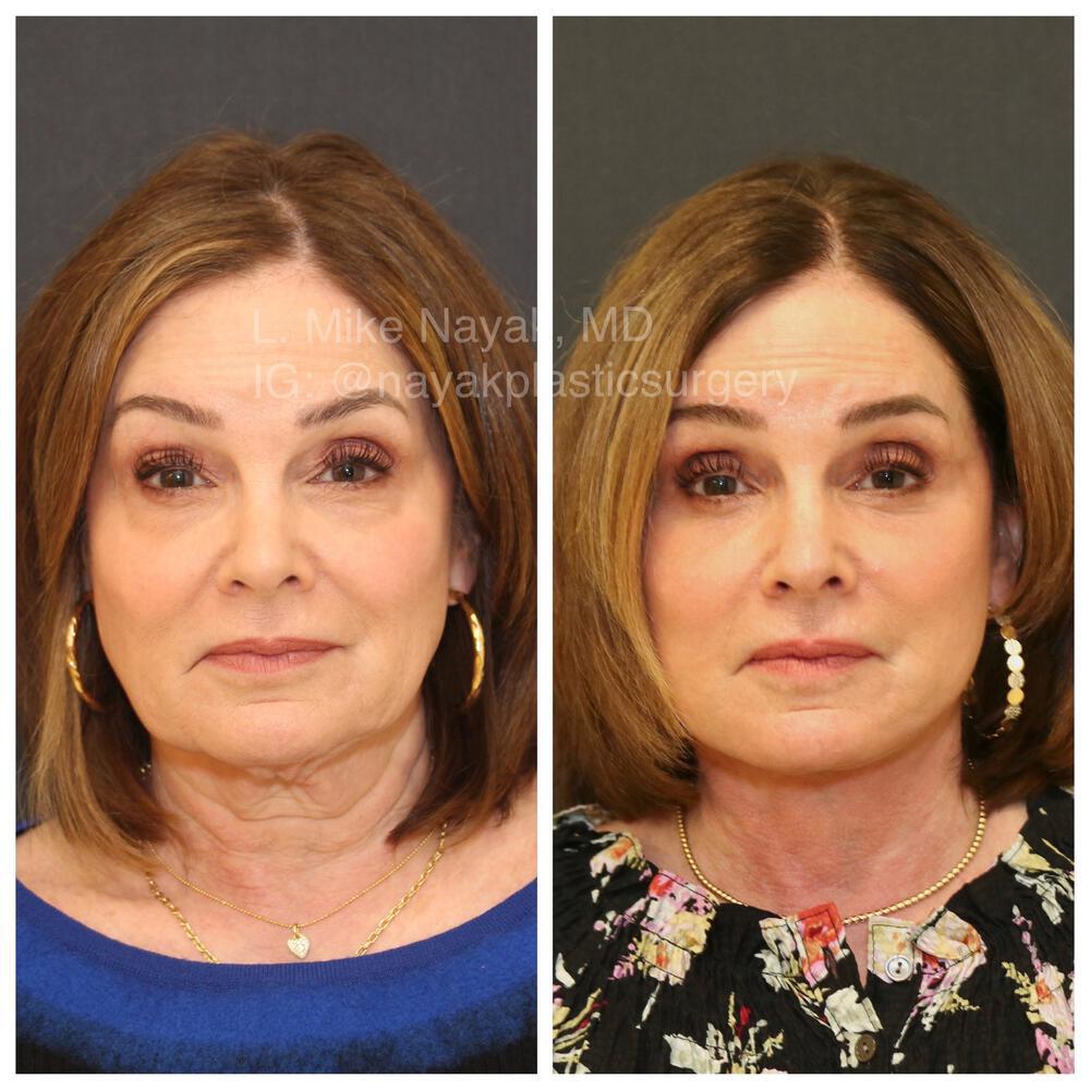 Deep Necklift Before & After Image