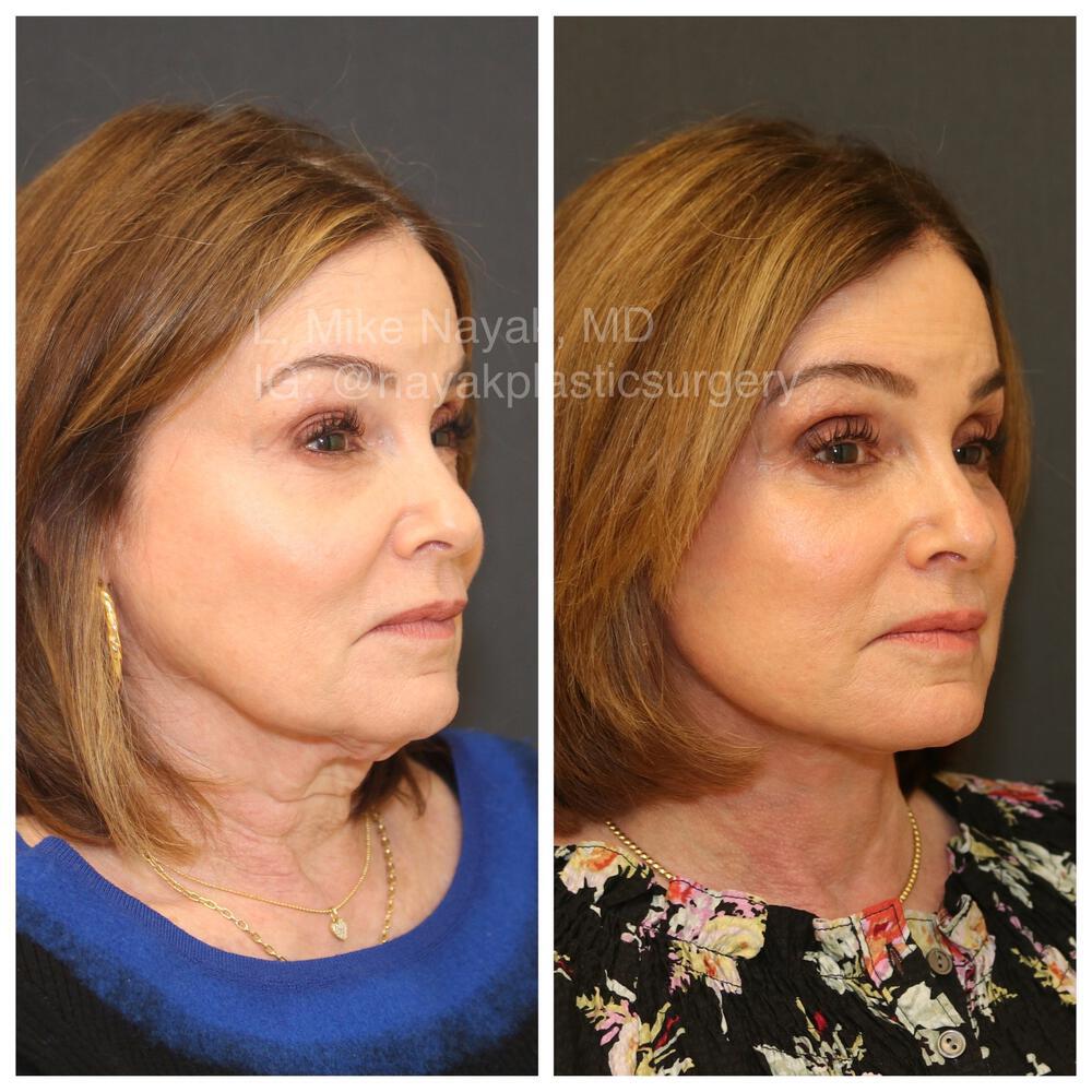 Deep Necklift Before & After Image