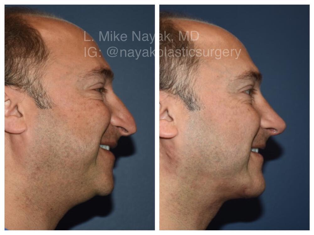 Deep Necklift Before & After Image