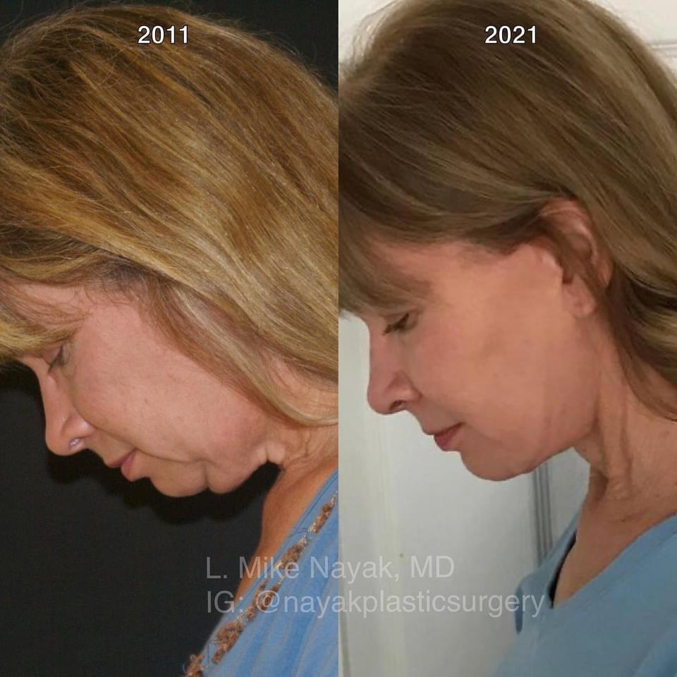 Deep Necklift Before & After Image