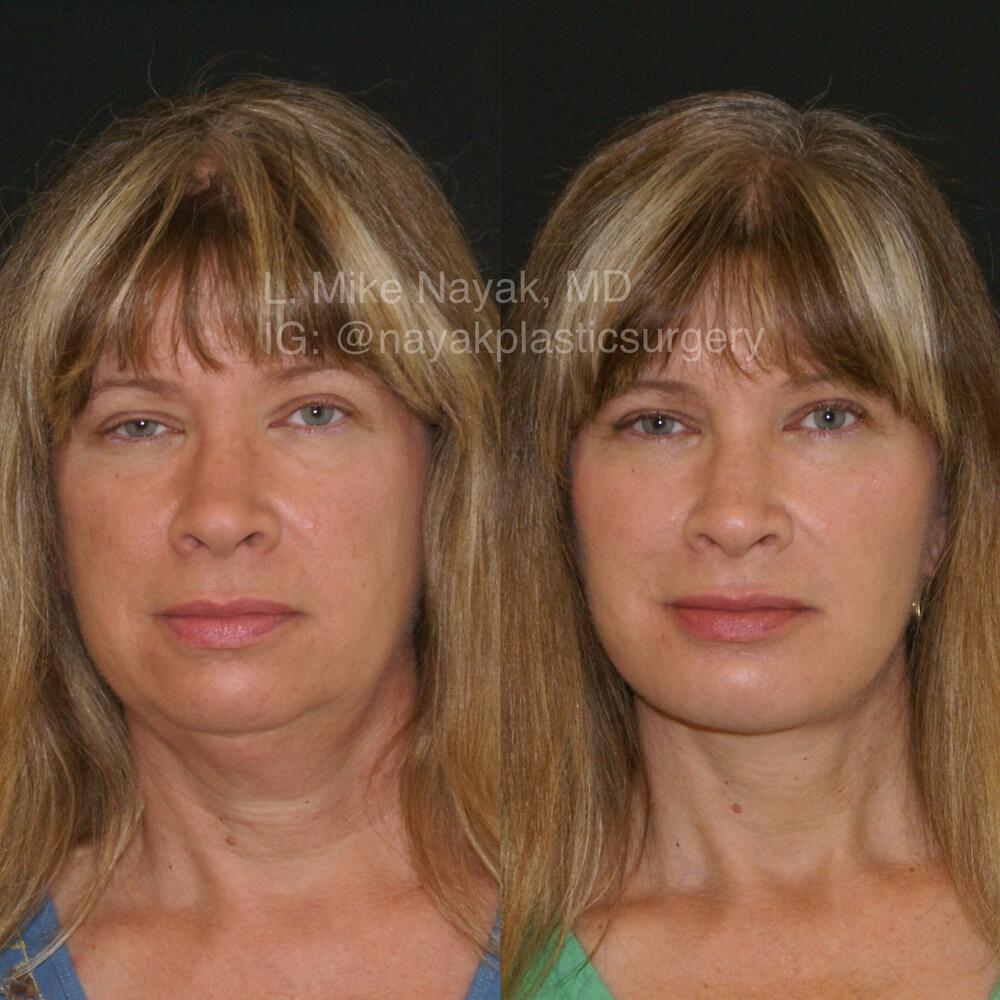 Deep Necklift Before & After Image