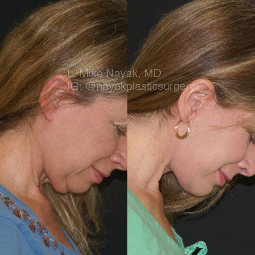 Deep Necklift Before & After Image