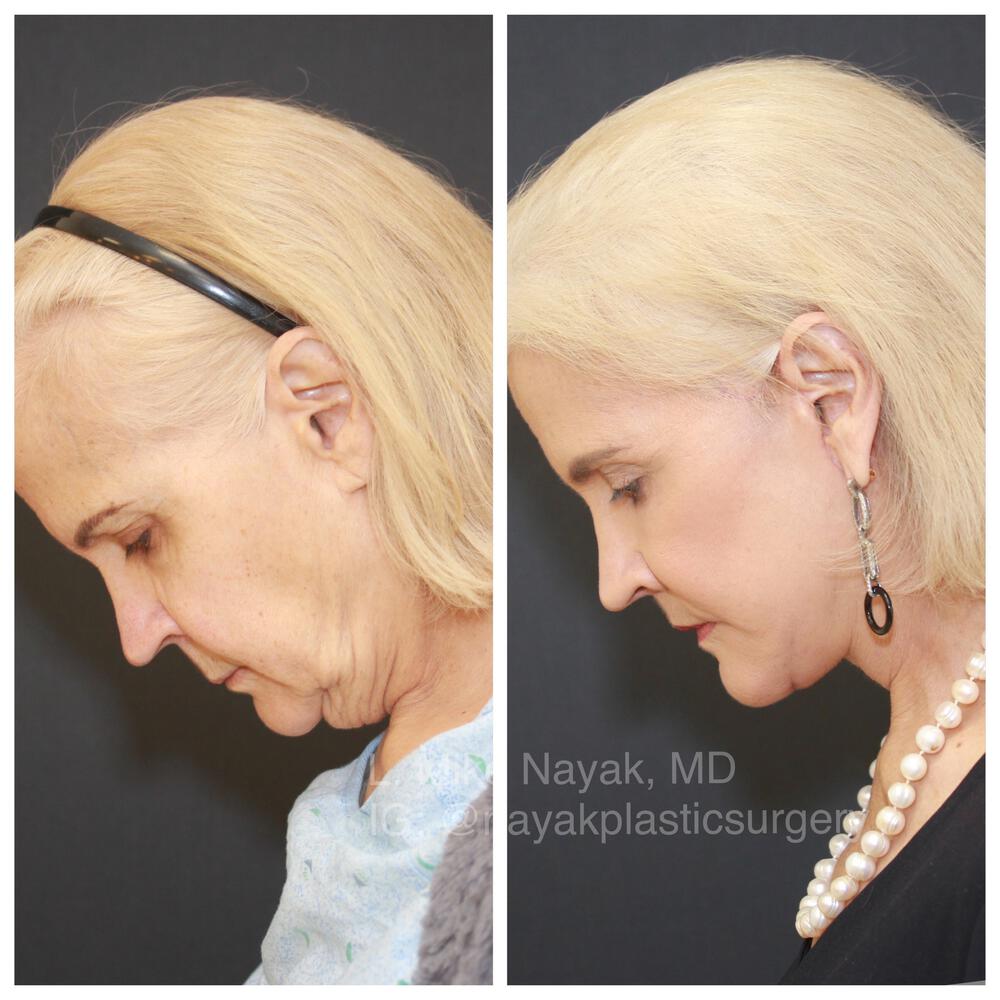 Deep Necklift Before & After Image