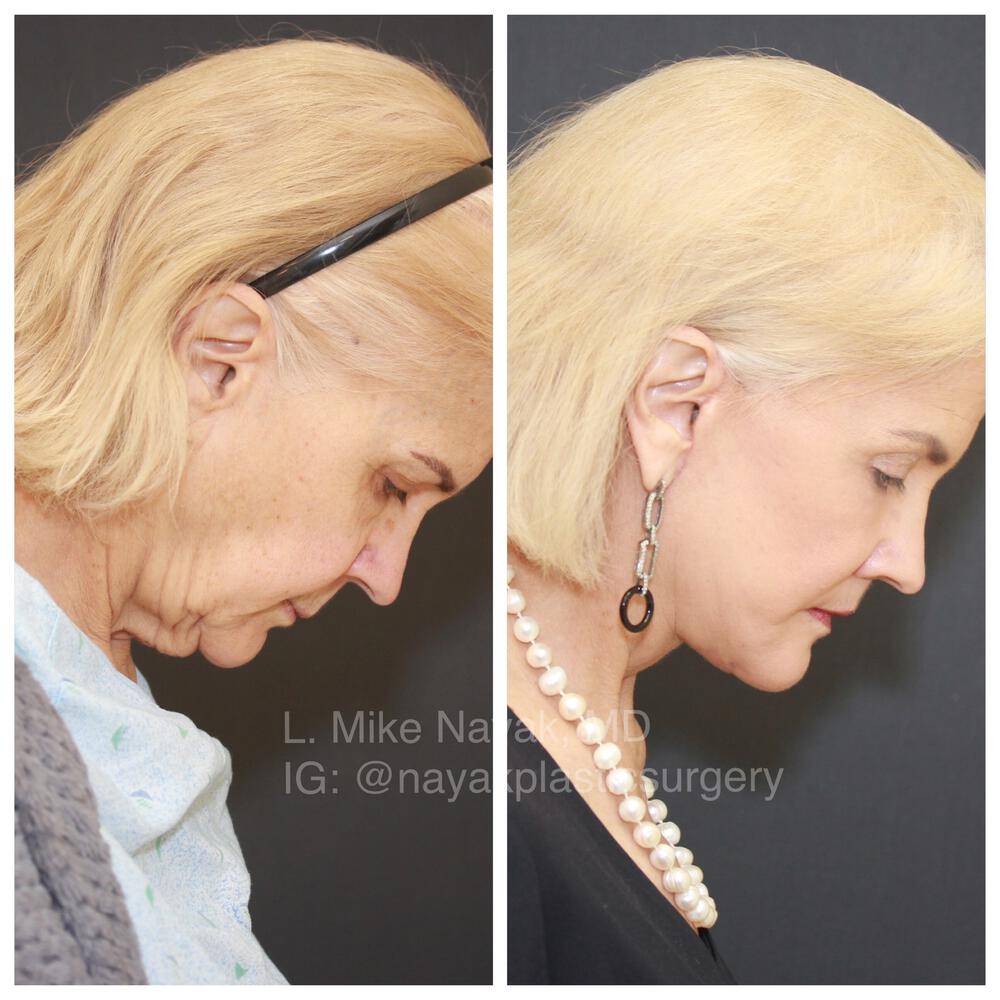 Deep Necklift Before & After Image