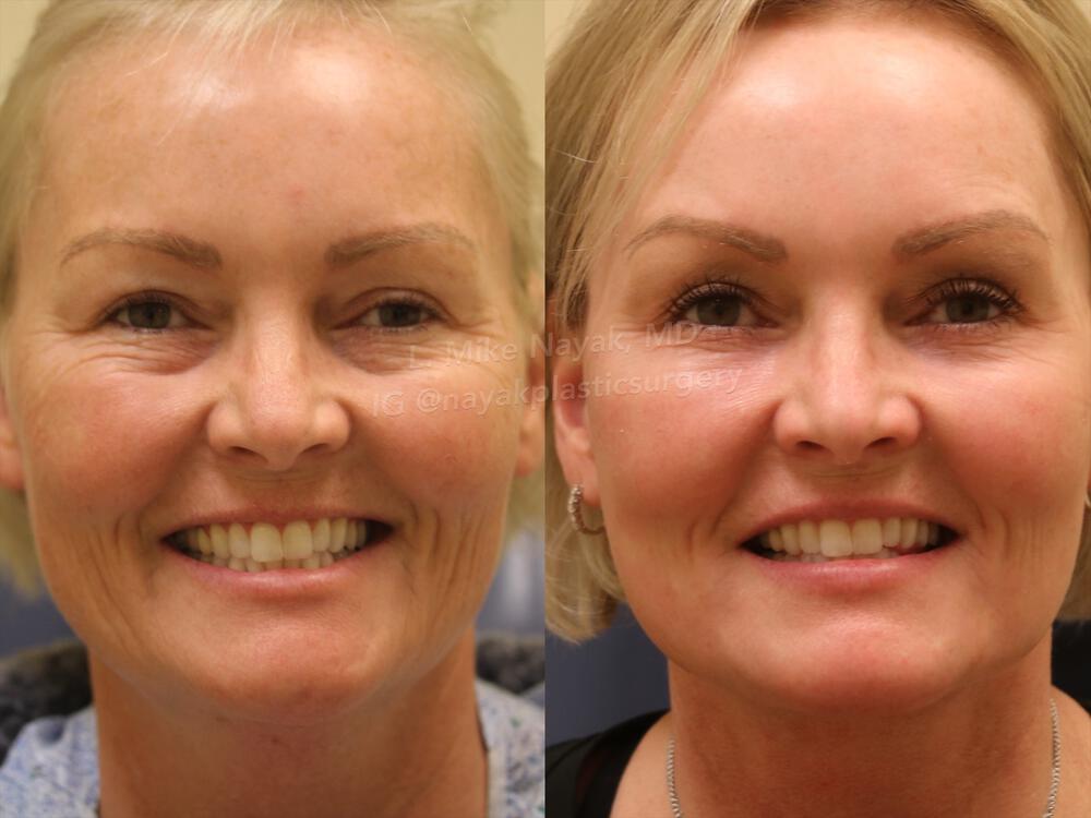 Deep Necklift Before & After Image