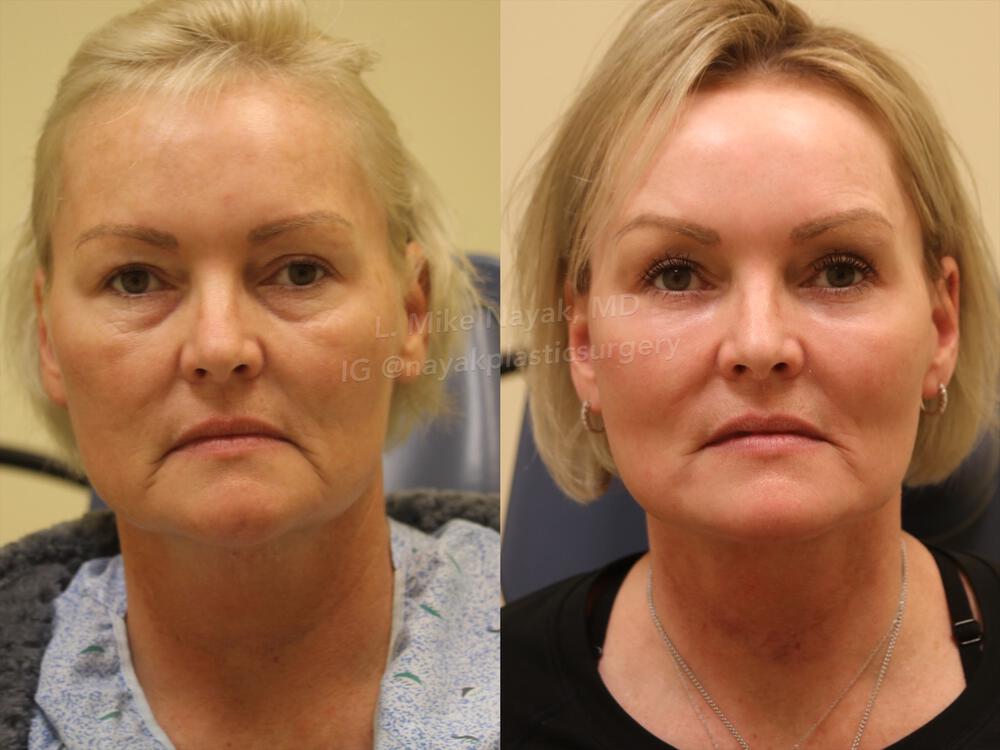 Deep Necklift Before & After Image