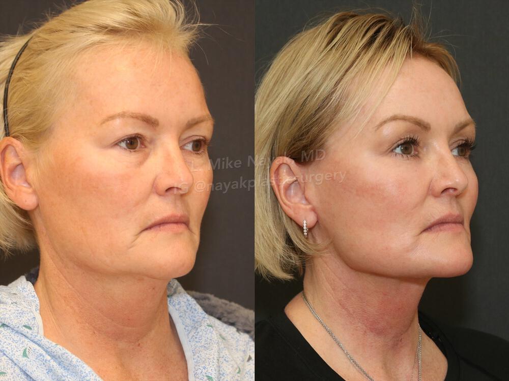 Deep Necklift Before & After Image