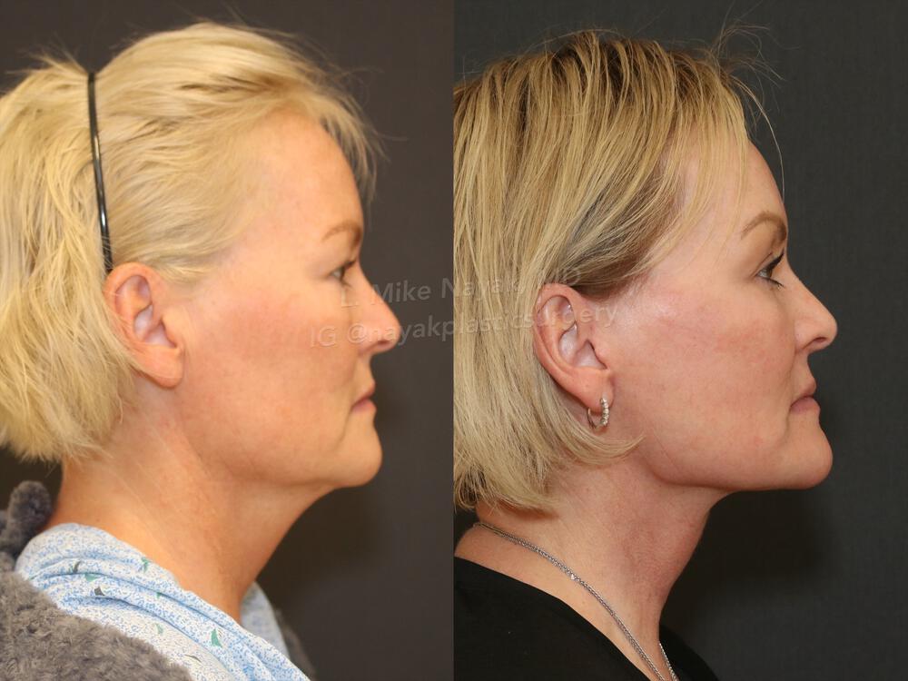 Deep Necklift Before & After Image