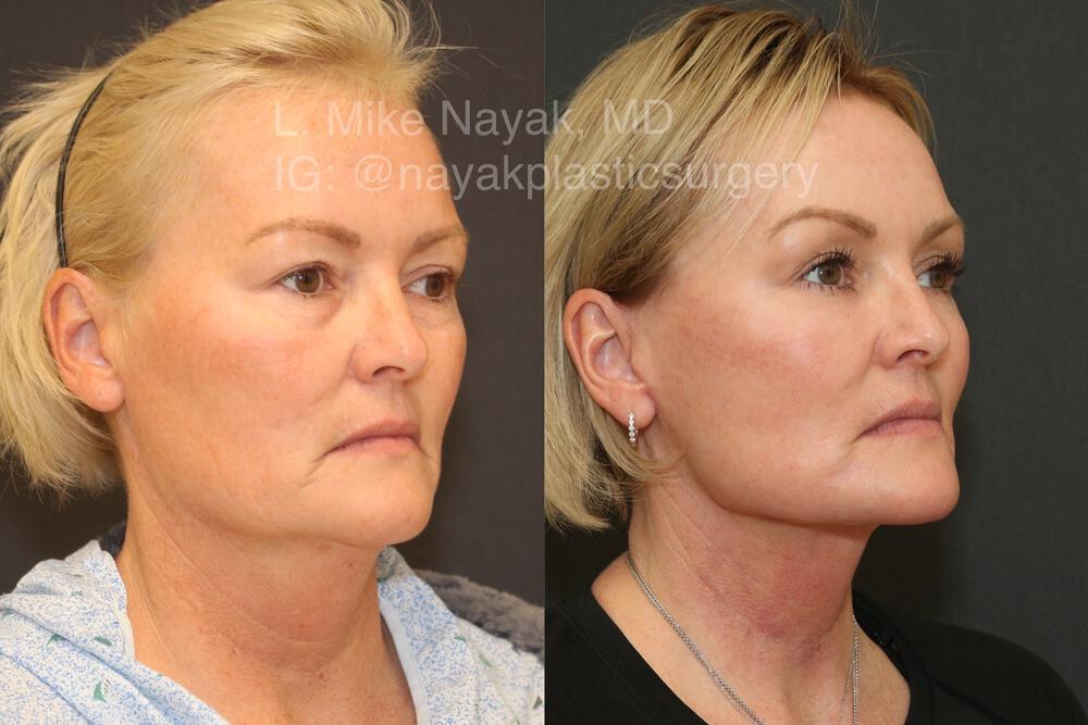 Deep Necklift Before & After Image