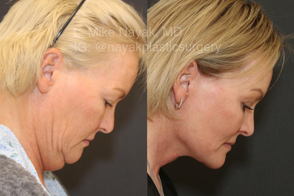 Deep Necklift Before & After Image