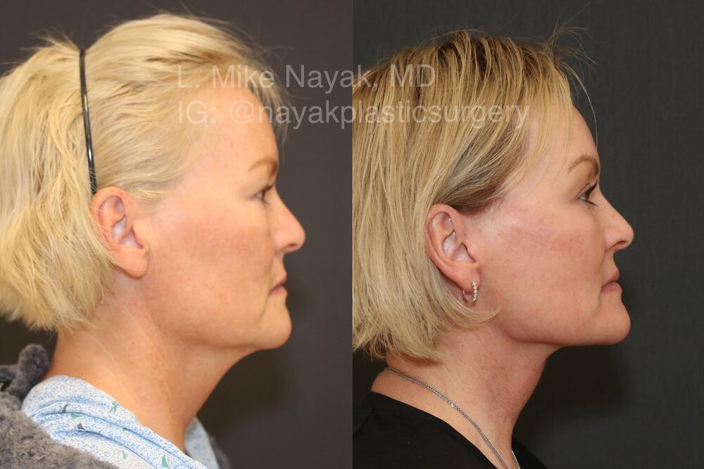 Deep Necklift Before & After Image