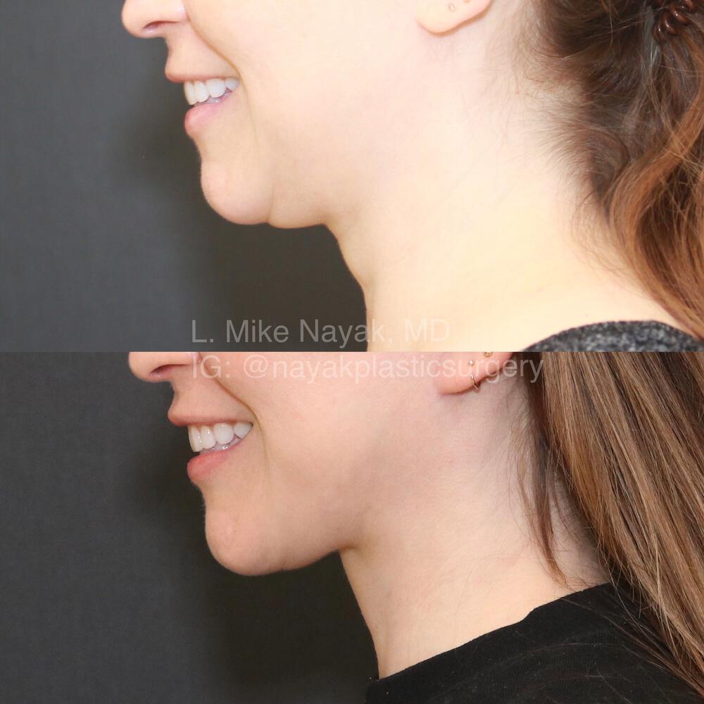 Deep Necklift Before & After Image