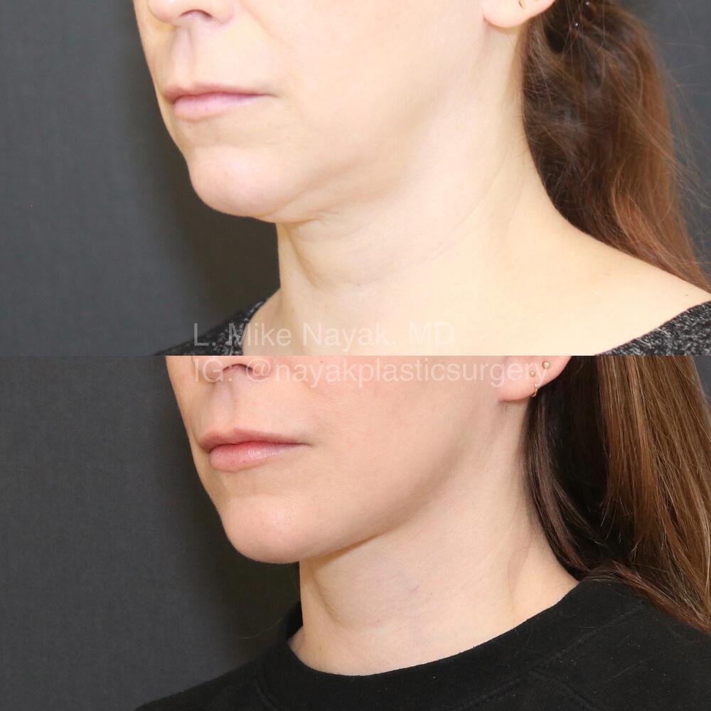 Deep Necklift Before & After Image