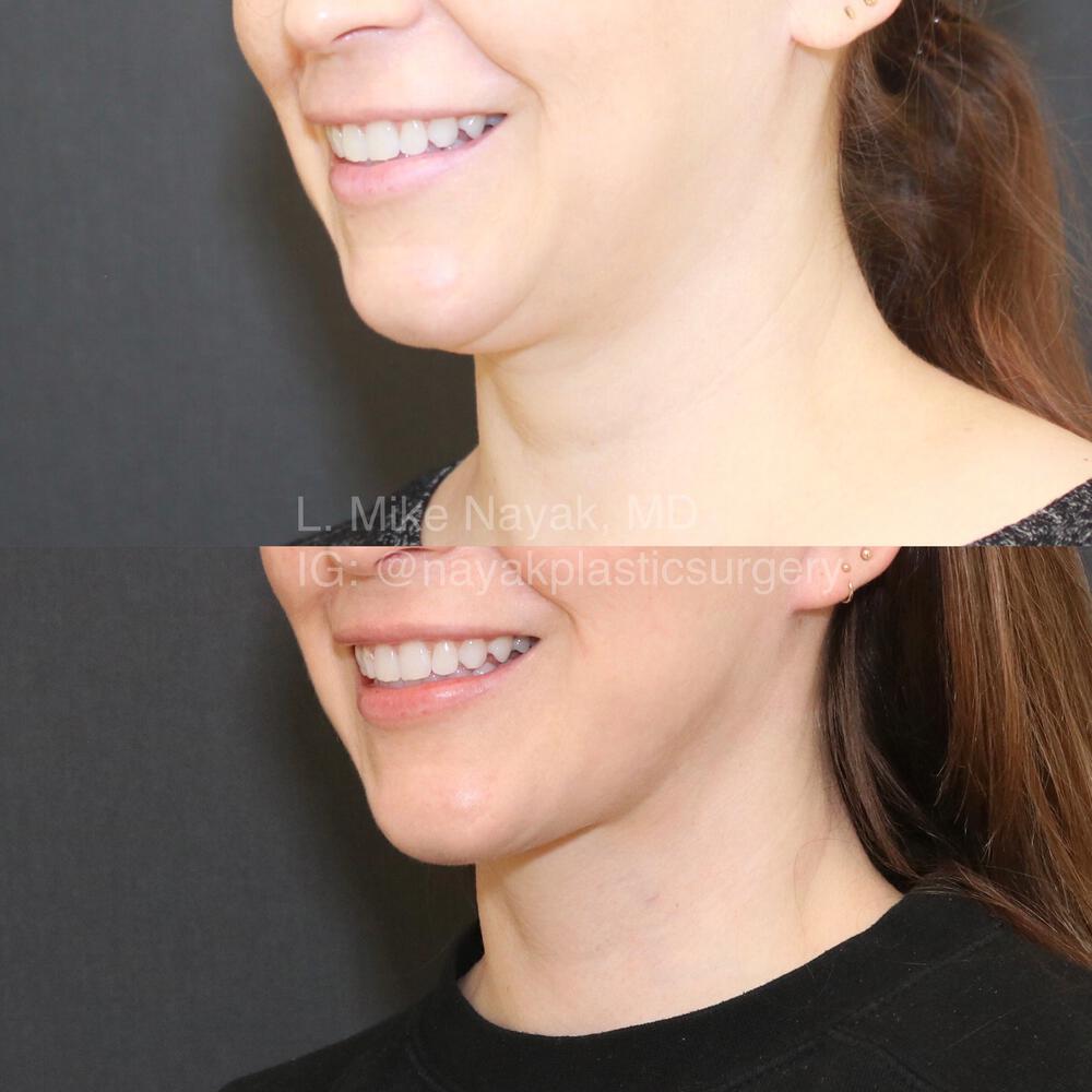 Deep Necklift Before & After Image