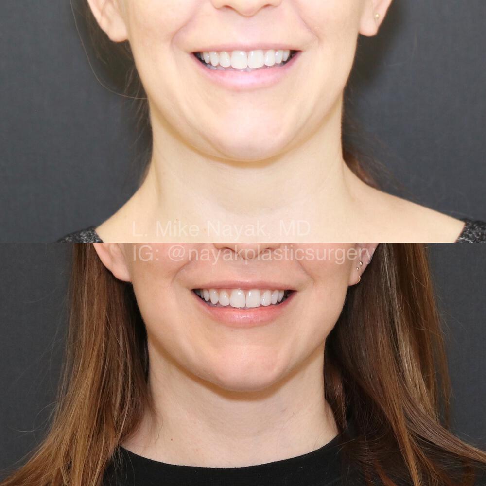 Deep Necklift Before & After Image