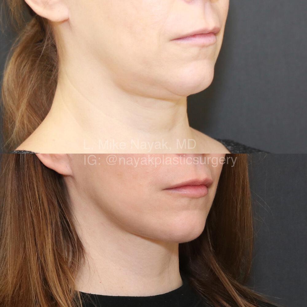 Deep Necklift Before & After Image