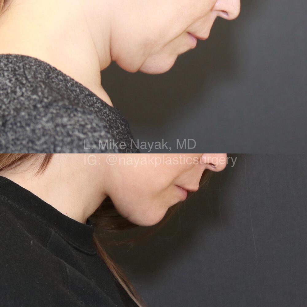 Deep Necklift Before & After Image