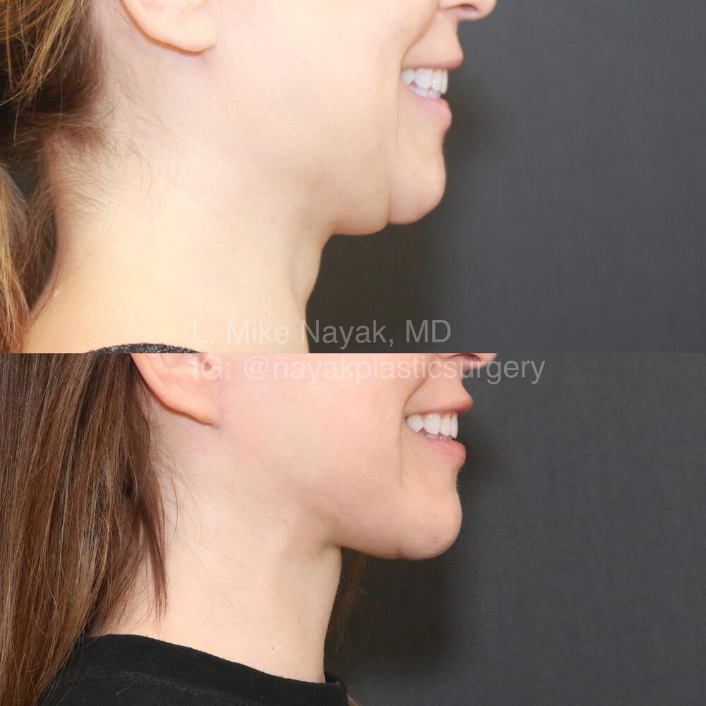 Deep Necklift Before & After Image