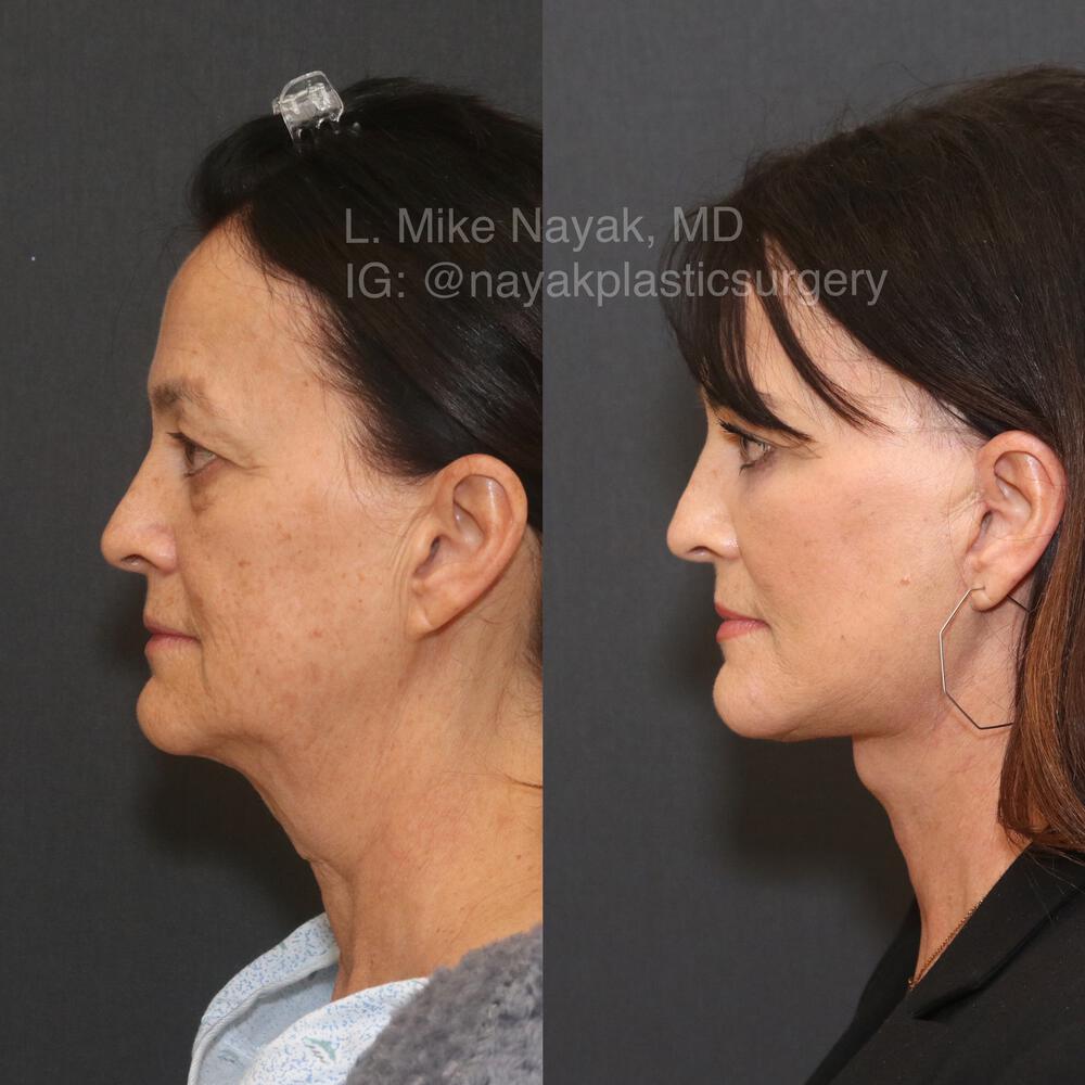 Deep Necklift Before & After Image