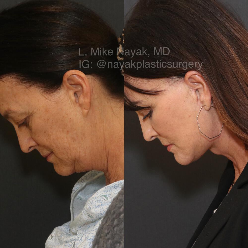 Deep Necklift Before & After Image