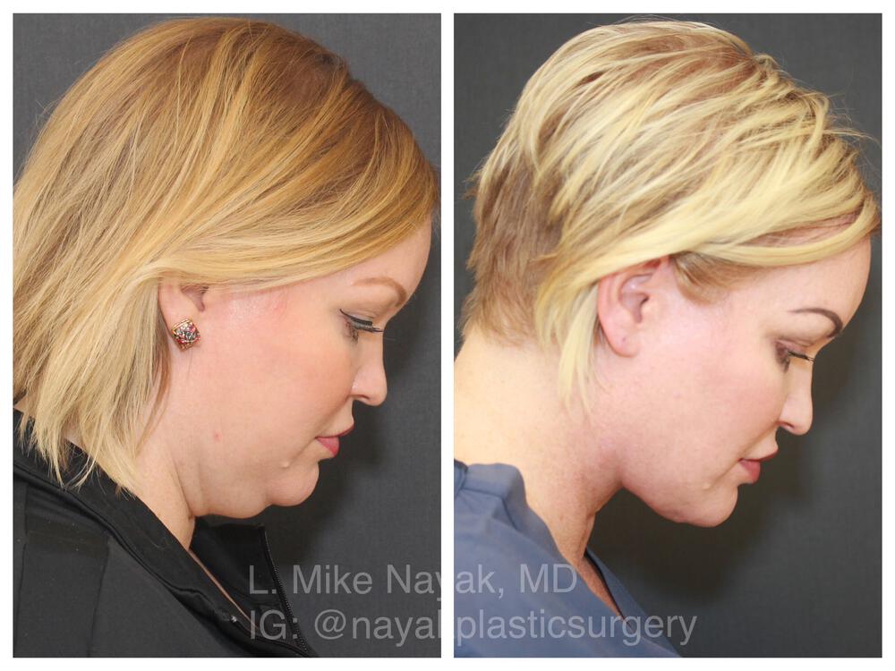 Deep Necklift Before & After Image