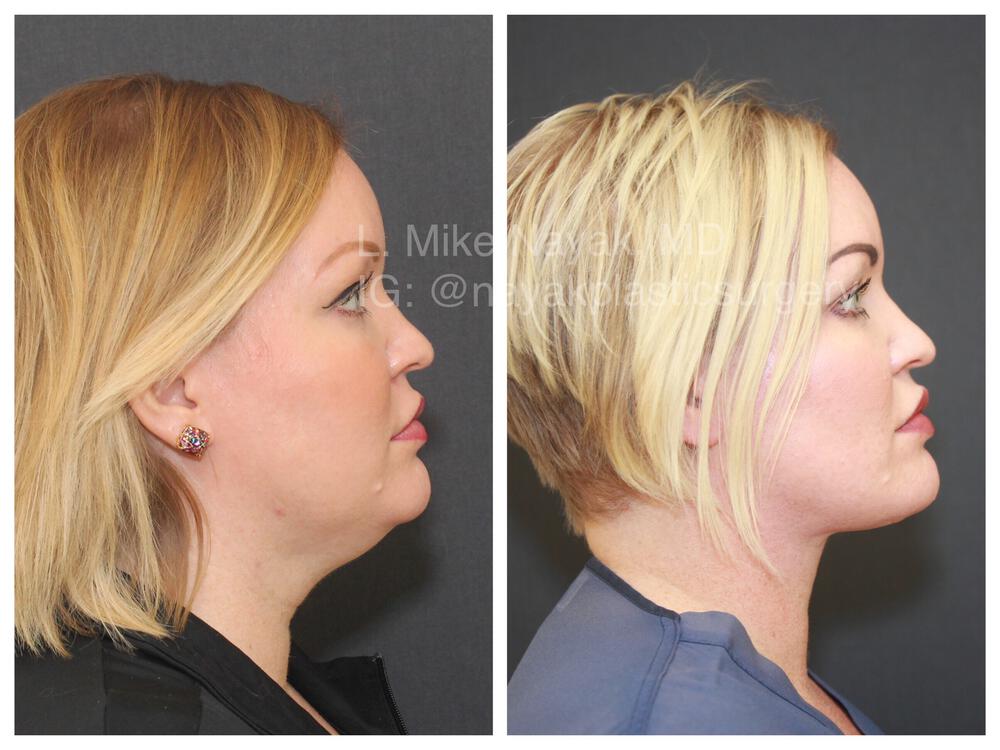 Deep Necklift Before & After Image