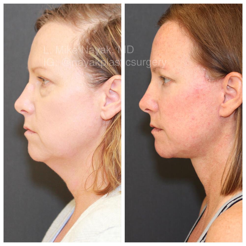 Deep Necklift Before & After Image