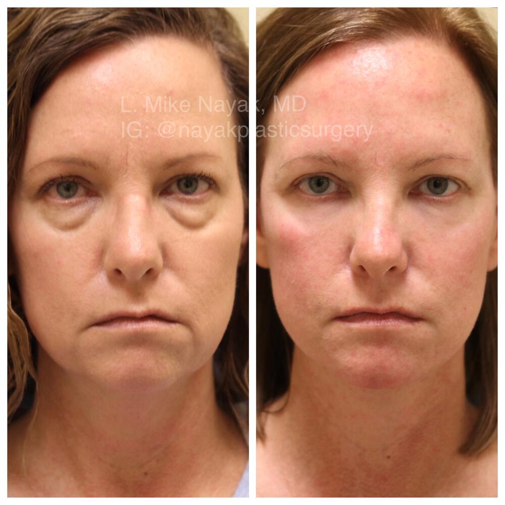 Deep Necklift Before & After Image